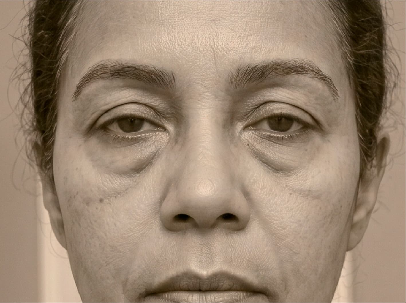 Blefaroplastia — antes