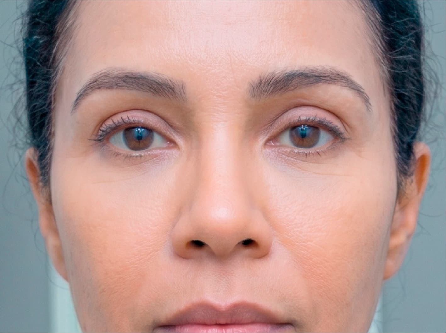 Blefaroplastia — después