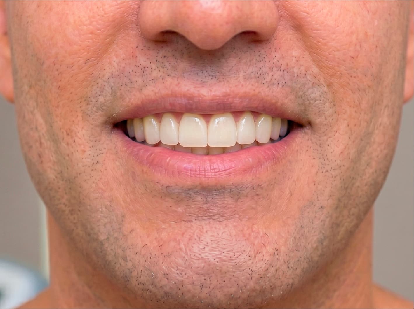 Implante Dental — Caso 2 — después