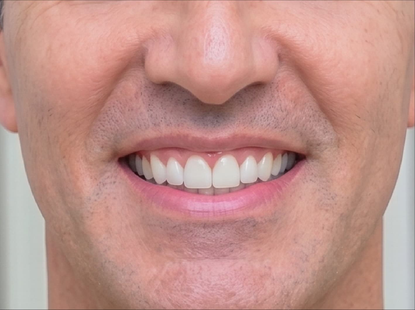 Cirugía Periodontal — después