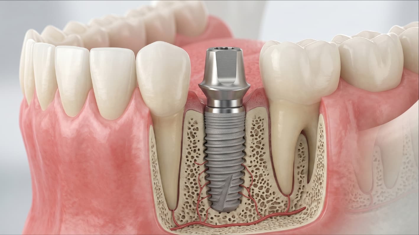 Render 3D de un implante dental de titanio en el hueso